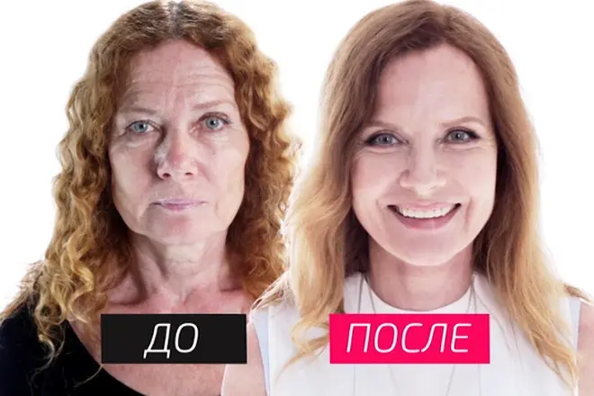 Irina Brazovka plastikten önce ve sonra