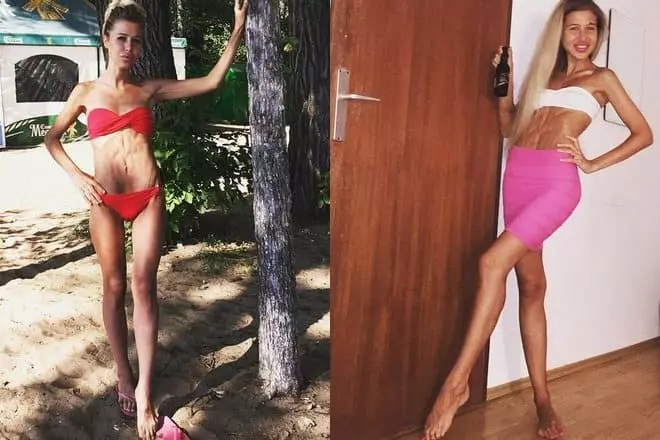 Anorexia Maria Kokhno.