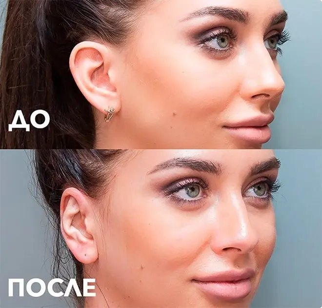 Tatiana Musulbes telinga sebelum dan sesudah plastik