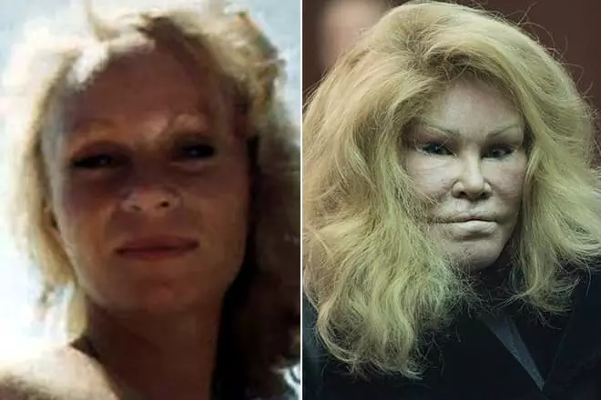 Joslin WildensHtein prije i poslije plastike
