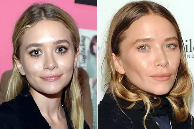 Plástico Mary-Kate Olsen: Antes e depois