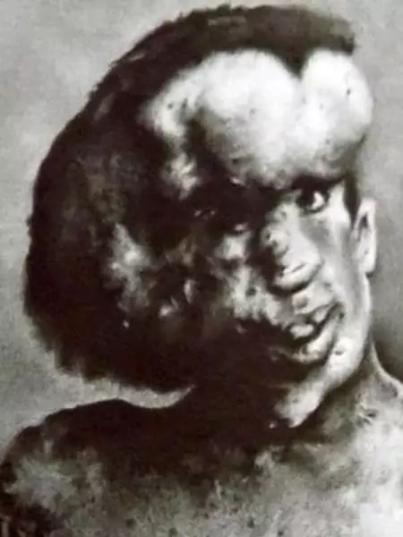 জোসেফ ম্যারিক - জীবনী, ছবি, একটি মানুষের হাতি ব্যক্তিগত জীবন