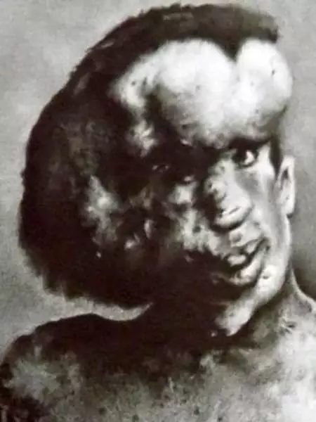 Joseph Merrick - Biografie, Foto, persönliches Leben eines menschlichen Elefanten