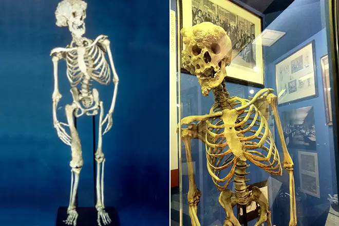 Skeleton Joseph Merrick.