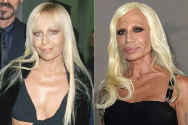 Donatella Versace pirms un pēc plastmasas