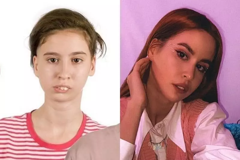 Anya Khakhastka ameliyattan önce ve sonra