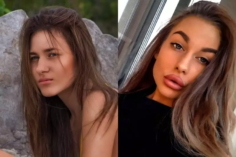 Milena Norina antes e depois dos plásticos