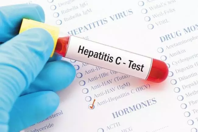 Hepatitis C - Gejala lan tandha