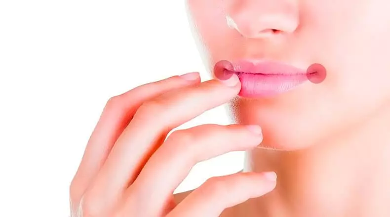 मुंह के कोनों में मकई: कारण और उपचार